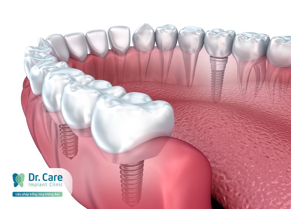 Vùng chân răng giả bị hôi: Nguyên nhân và cách khắc phục triệt để