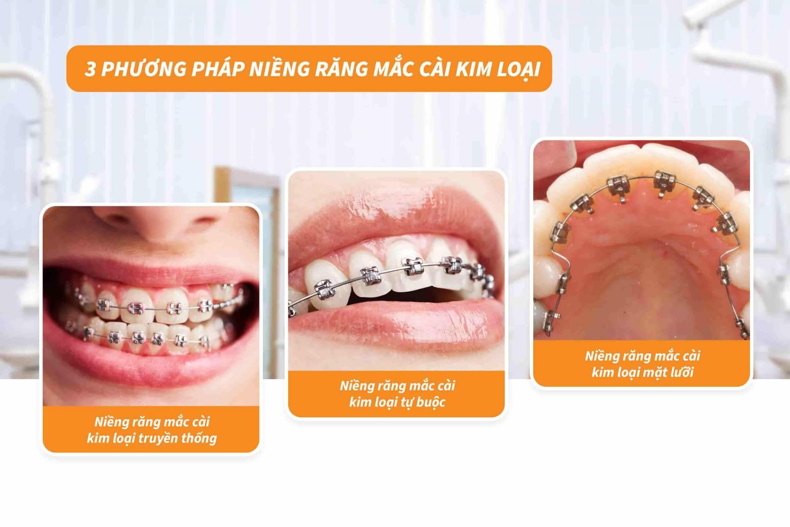 03 phương pháp niềng răng mắc cài kim loại