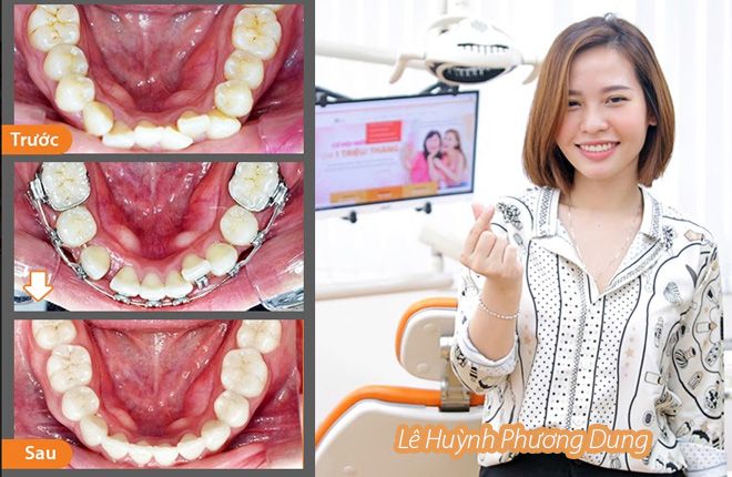 hinh-anh-truoc-va-sau-khi-nieng-rang-tai-up-dental