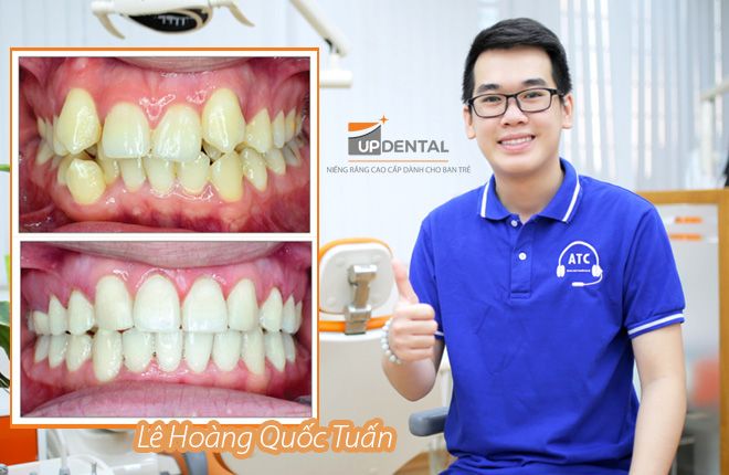 hinh-anh-truoc-va-sau-khi-nieng-rang-tai-up-dental