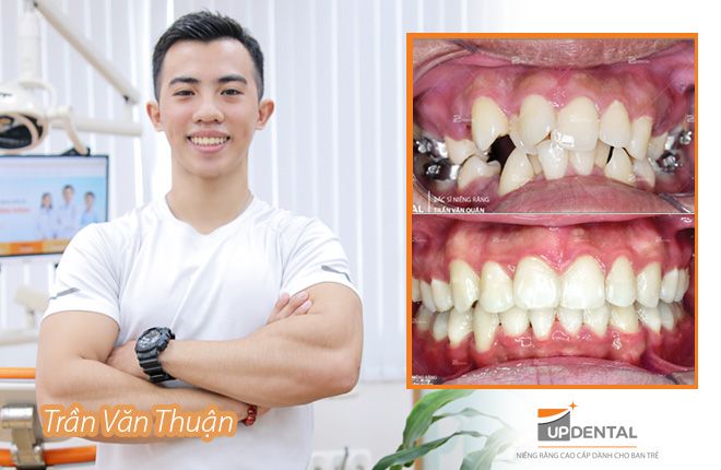 hinh-anh-truoc-va-sau-khi-nieng-rang-tai-up-dental