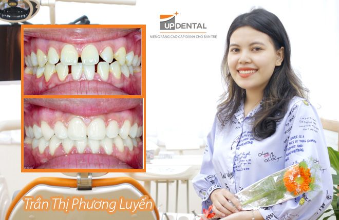 hinh-anh-truoc-va-sau-khi-nieng-rang-tai-up-dental