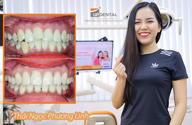 hinh-anh-truoc-va-sau-khi-nieng-rang-tai-up-dental