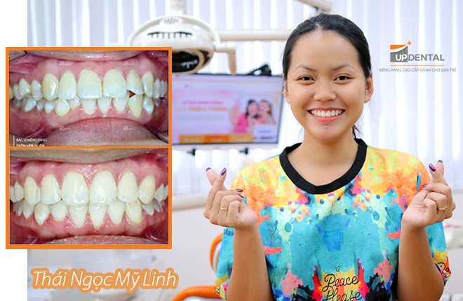 hinh-anh-truoc-va-sau-khi-nieng-rang-tai-up-dental