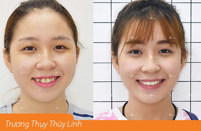 hinh-anh-truoc-va-sau-khi-nieng-rang-tai-up-dental