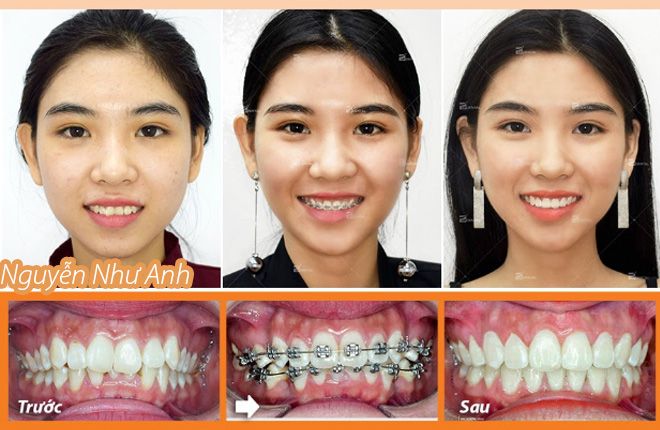 hinh-anh-truoc-va-sau-khi-nieng-rang-tai-up-dental