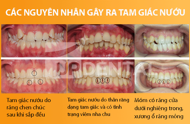 Nguyên nhân tam giác nướu khi niềng răng