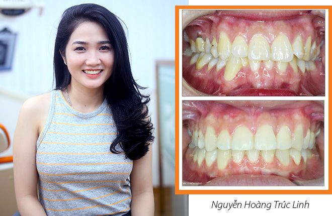 hinh-anh-truoc-va-sau-khi-nieng-rang-tai-up-dental