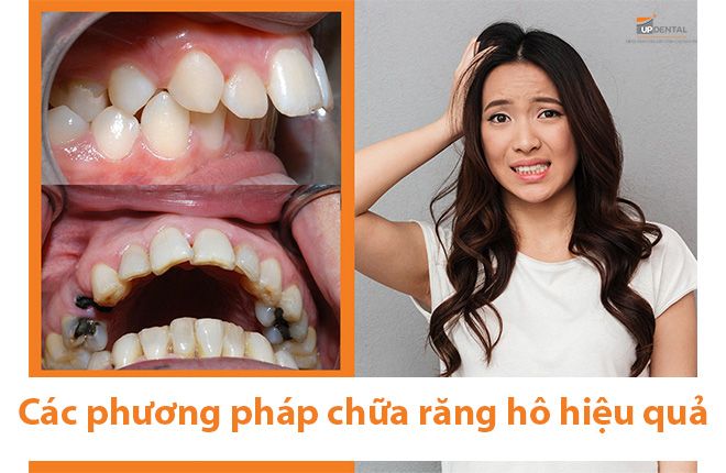 các phương pháp niềng răng hô