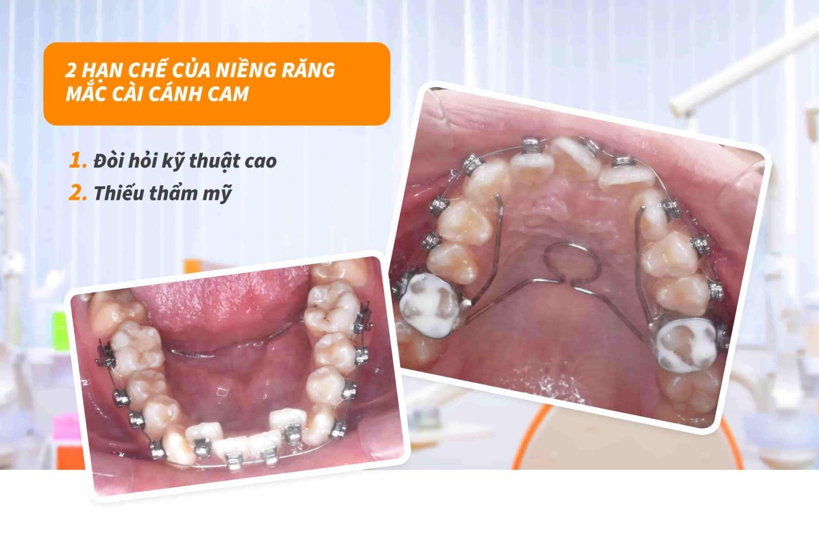 2 Hạn chế của niềng răng mắc cài cánh cam