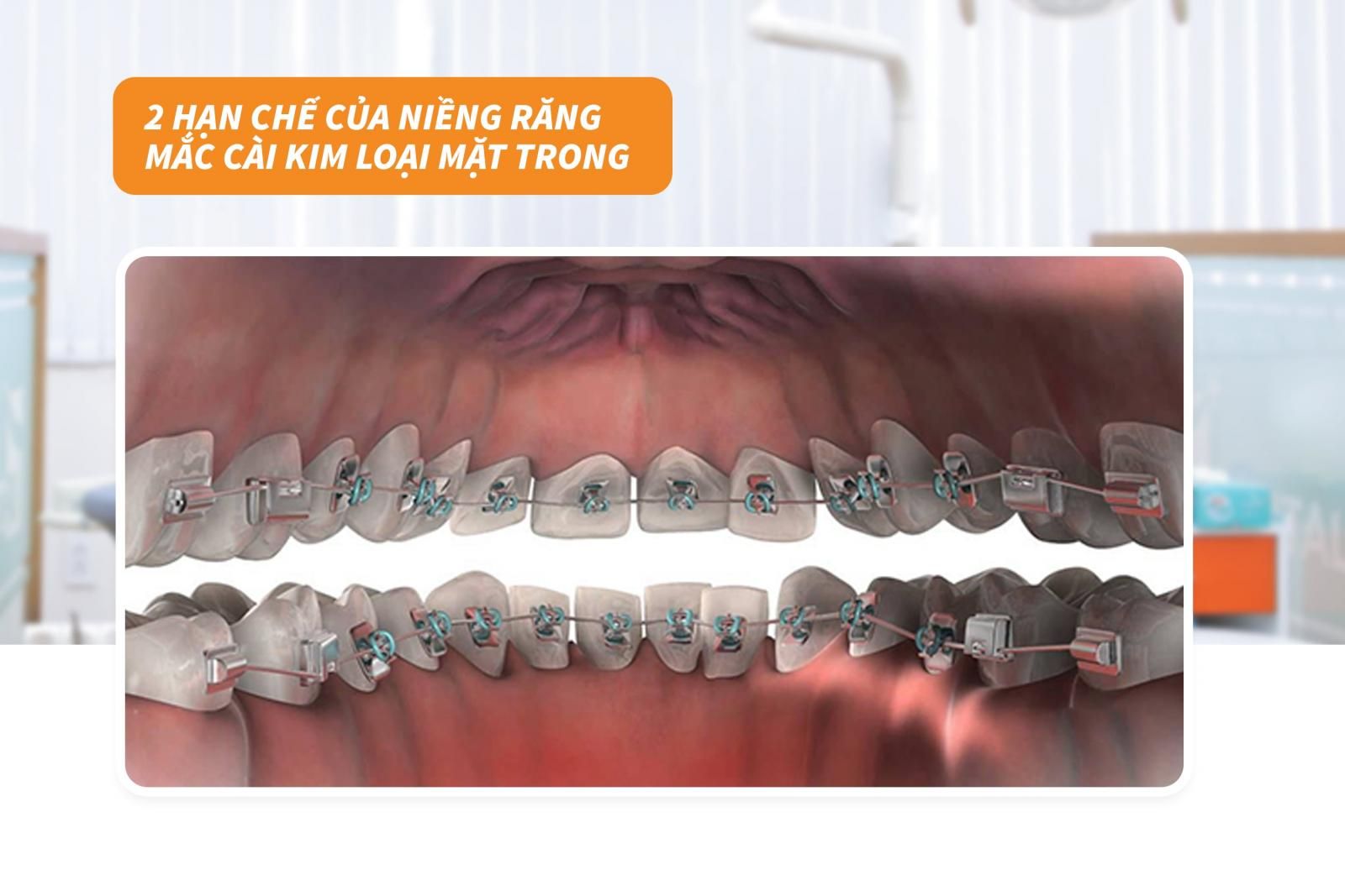 02 hạn chế của niềng răng mắc cài kim loại mặt trong