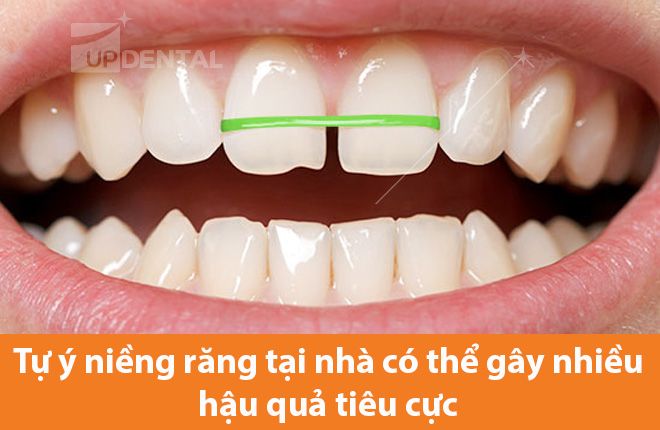 hậu quả tự niềng răng tại nhà