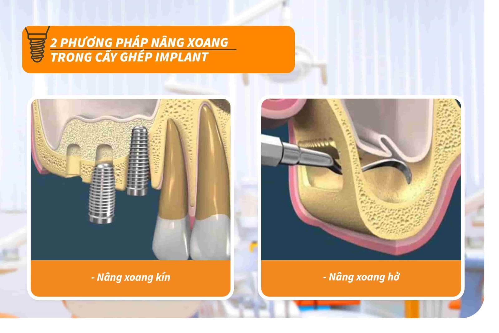 Các phương pháp nâng xoang trong cấy ghép Implant