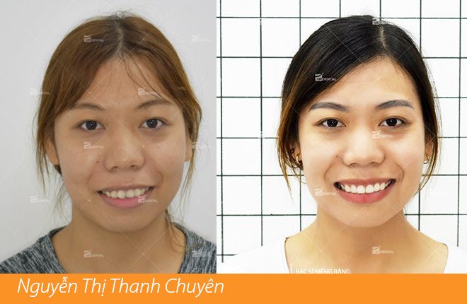 hinh-anh-truoc-va-sau-khi-nieng-rang-tai-up-dental