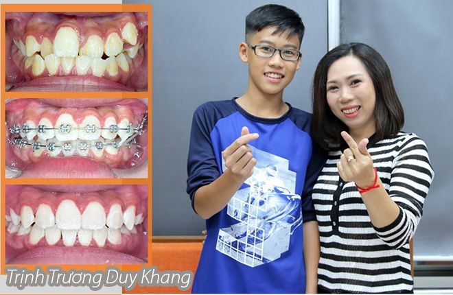 hinh-anh-truoc-va-sau-khi-nieng-rang-tai-up-dental