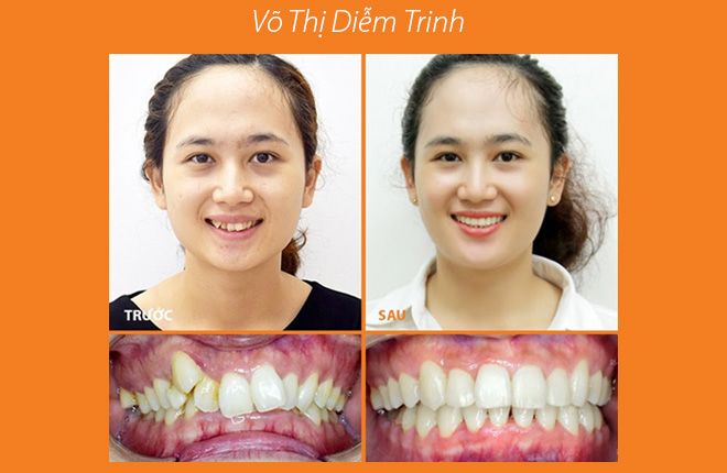 hinh-anh-truoc-va-sau-khi-nieng-rang-tai-up-dental