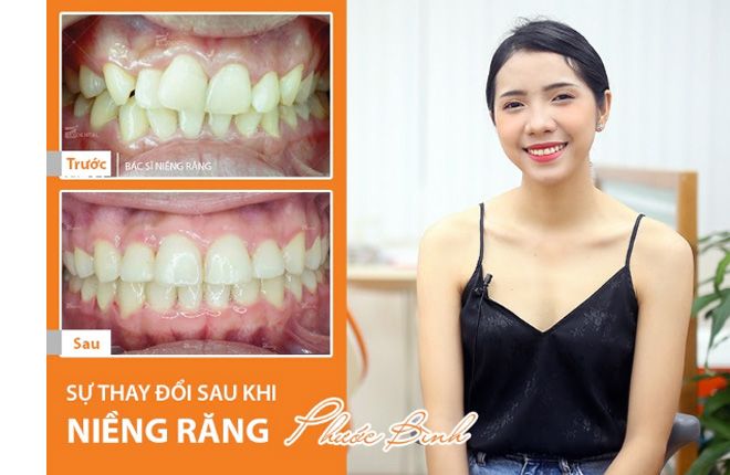 hinh-anh-truoc-va-sau-khi-nieng-rang-tai-up-dental