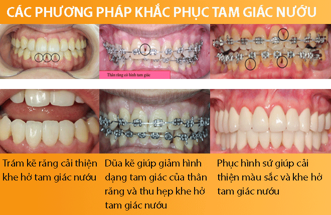 Các phương pháp khắc phục tam giác nướu sau niềng răng