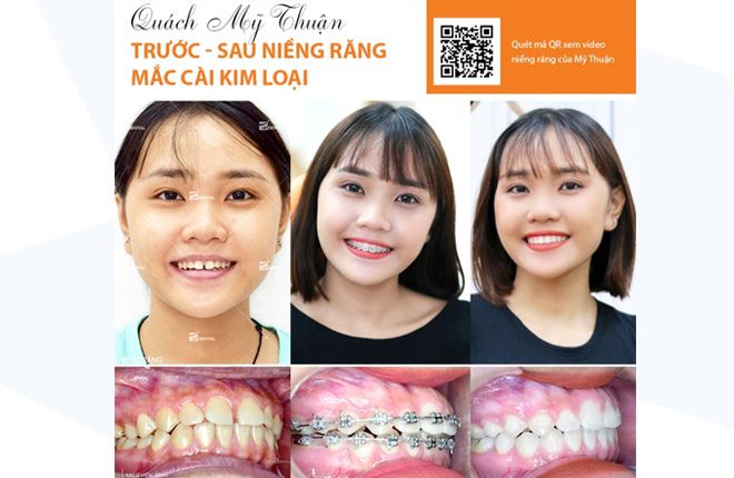 hinh-anh-truoc-va-sau-khi-nieng-rang-tai-up-dental