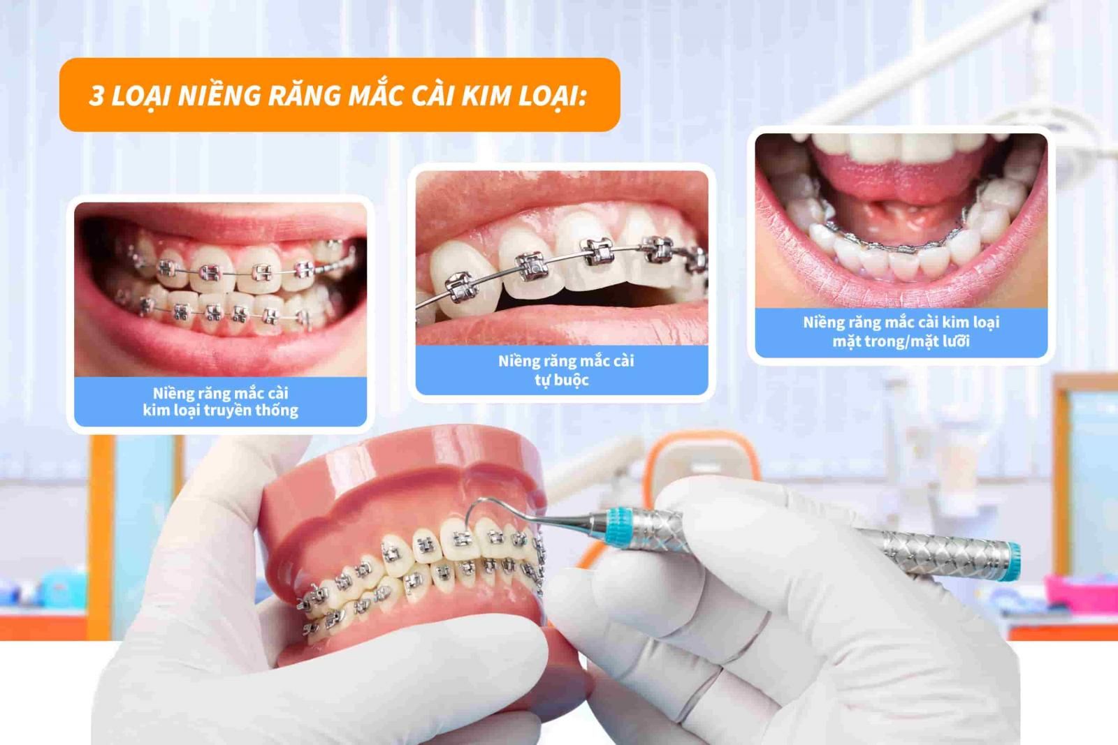 3 loại niềng răng mắc cài kim loại