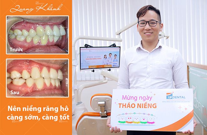 niềng răng càng sớm càng tốt