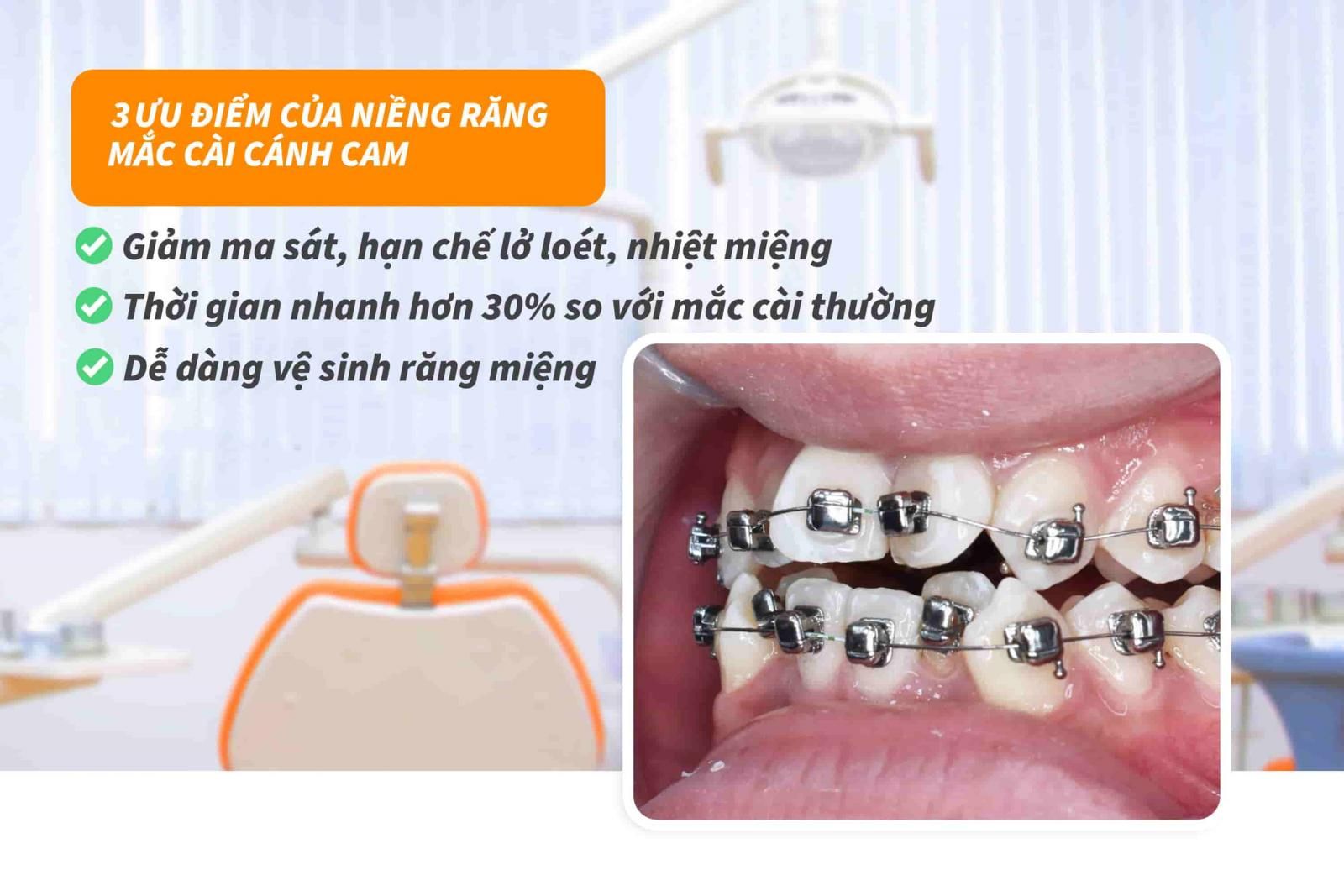 3 Ưu điểm của niềng răng mắc cài cánh cam