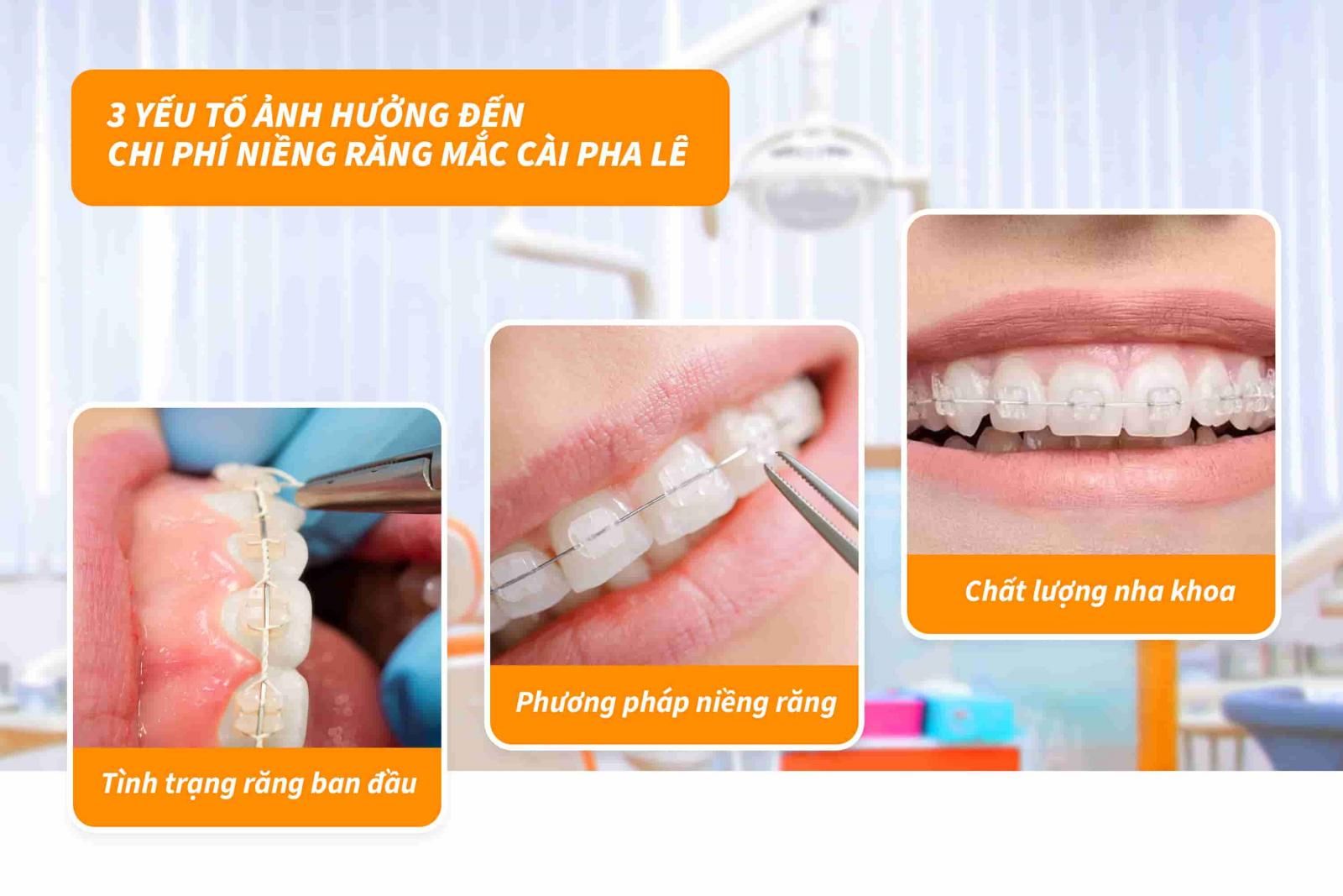 Yếu tố ảnh hưởng đến chi phí niềng răng mắc cài pha lê