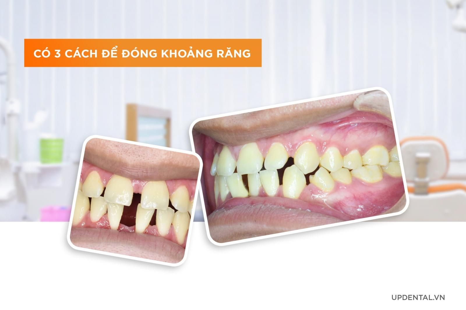 Giai đoạn niềng răng đóng khoảng niềng răng