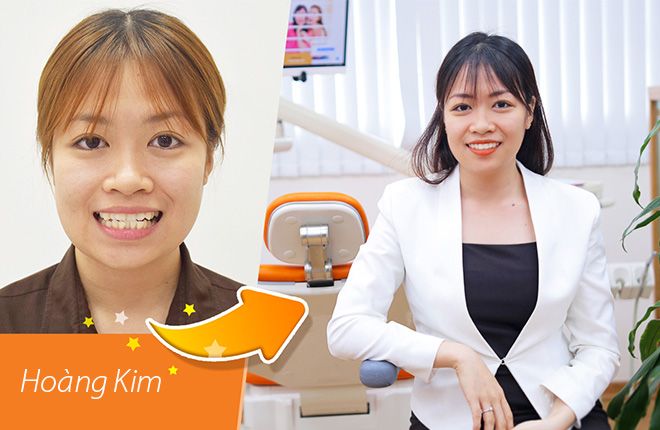 hinh-anh-truoc-va-sau-khi-nieng-rang-tai-up-dental