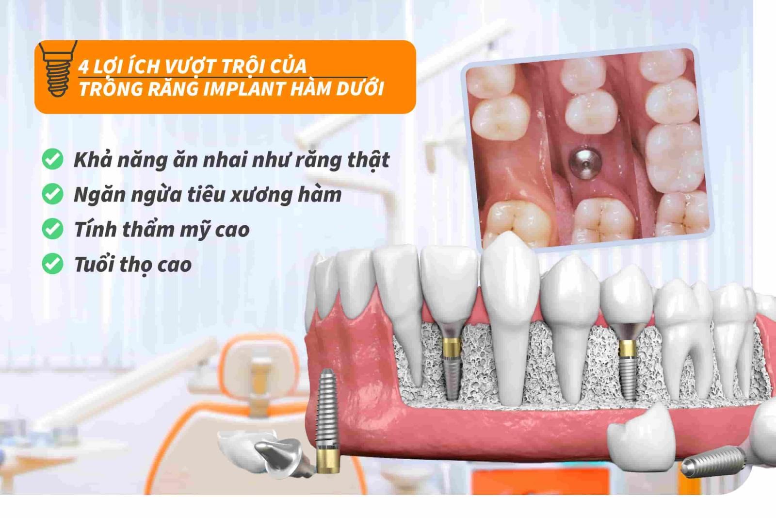 Lợi ích vượt trội của trồng răng Implant hàm dưới