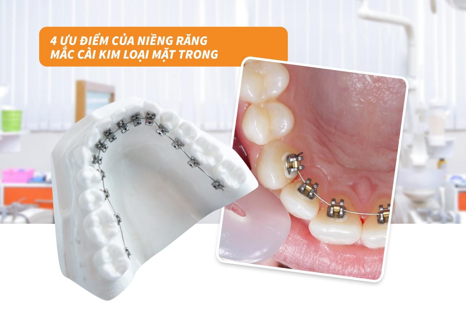 4 ưu điểm của niềng răng mắc cài kim loại mặt trong 