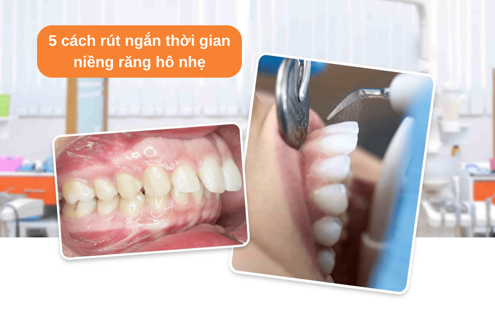 5 cách rút ngắn thời gian niềng răng hô nhẹ