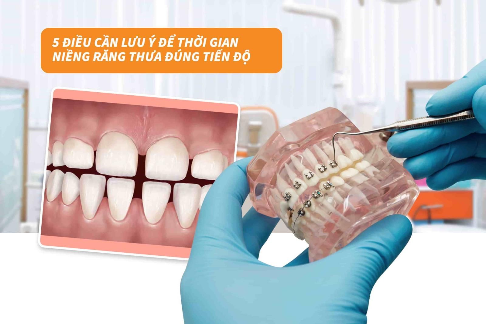 5 điều cần lưu ý để thời gian niềng răng thưa đúng tiến độ