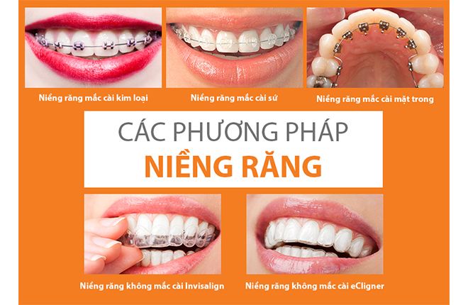 các phương pháp niềng răng thưa