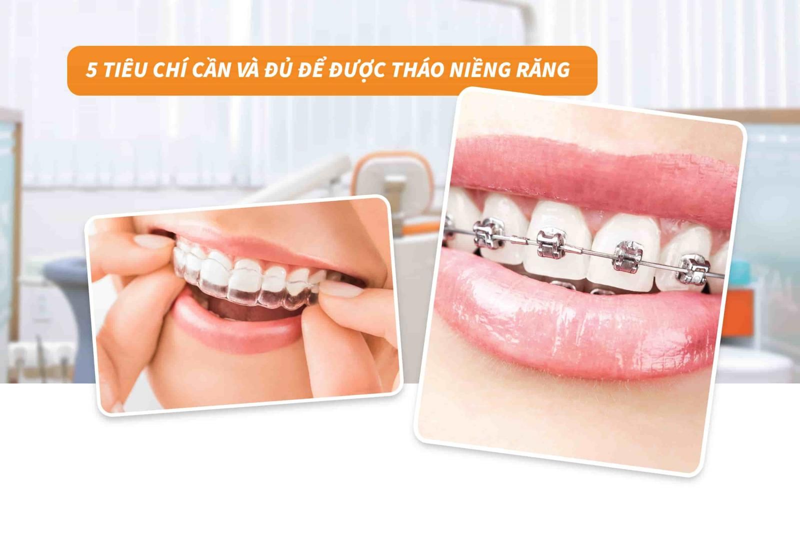 5 tiêu chí cần và đủ để được tháo niềng