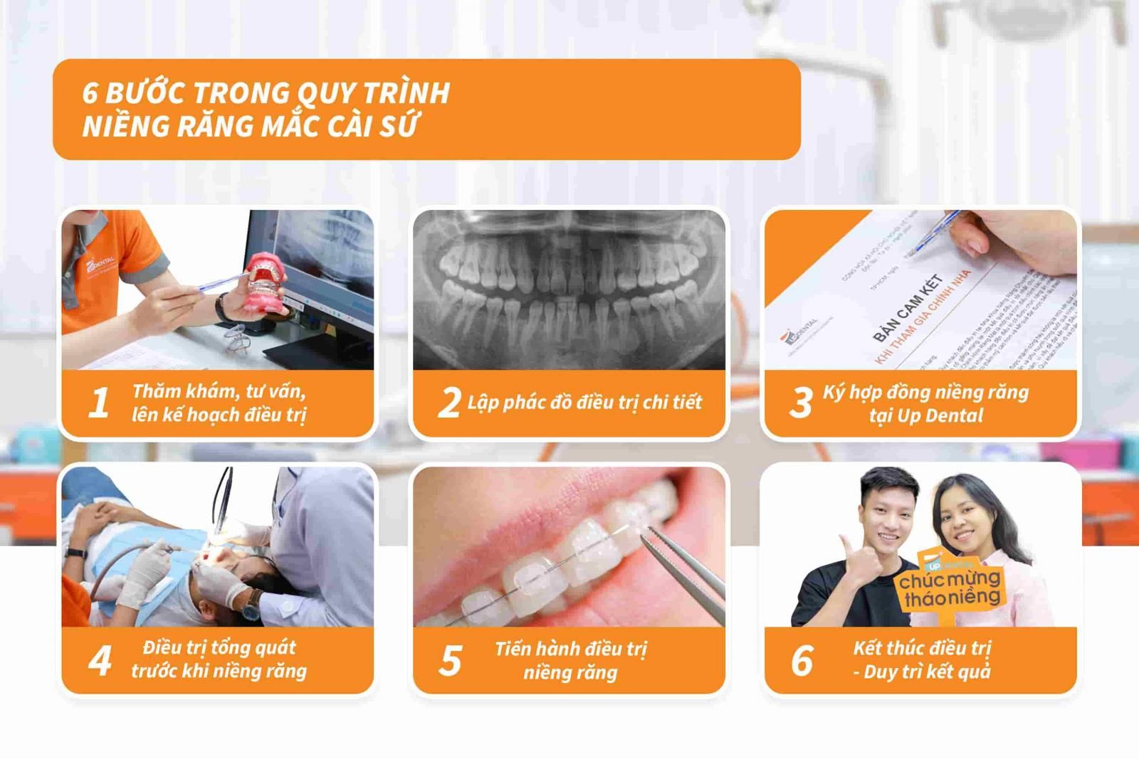 06 bước trong quy trình niềng răng mắc cài sứ 