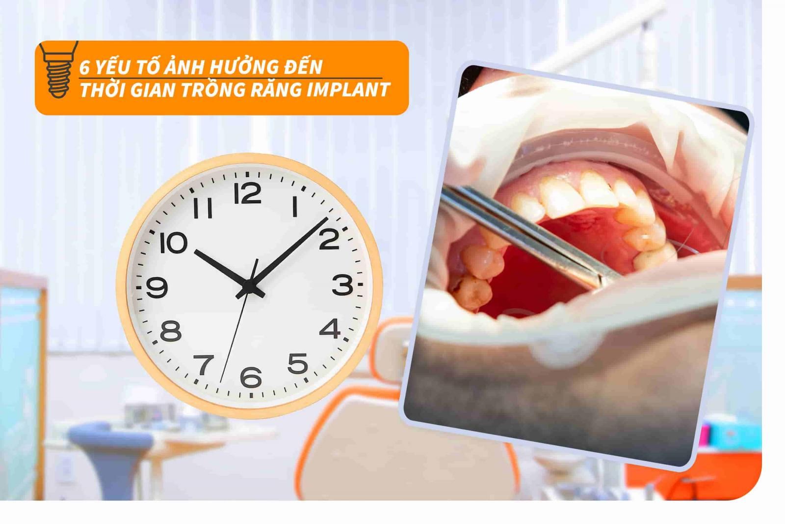 6 yếu tố ảnh hưởng đến thời gian trồng răng Implant