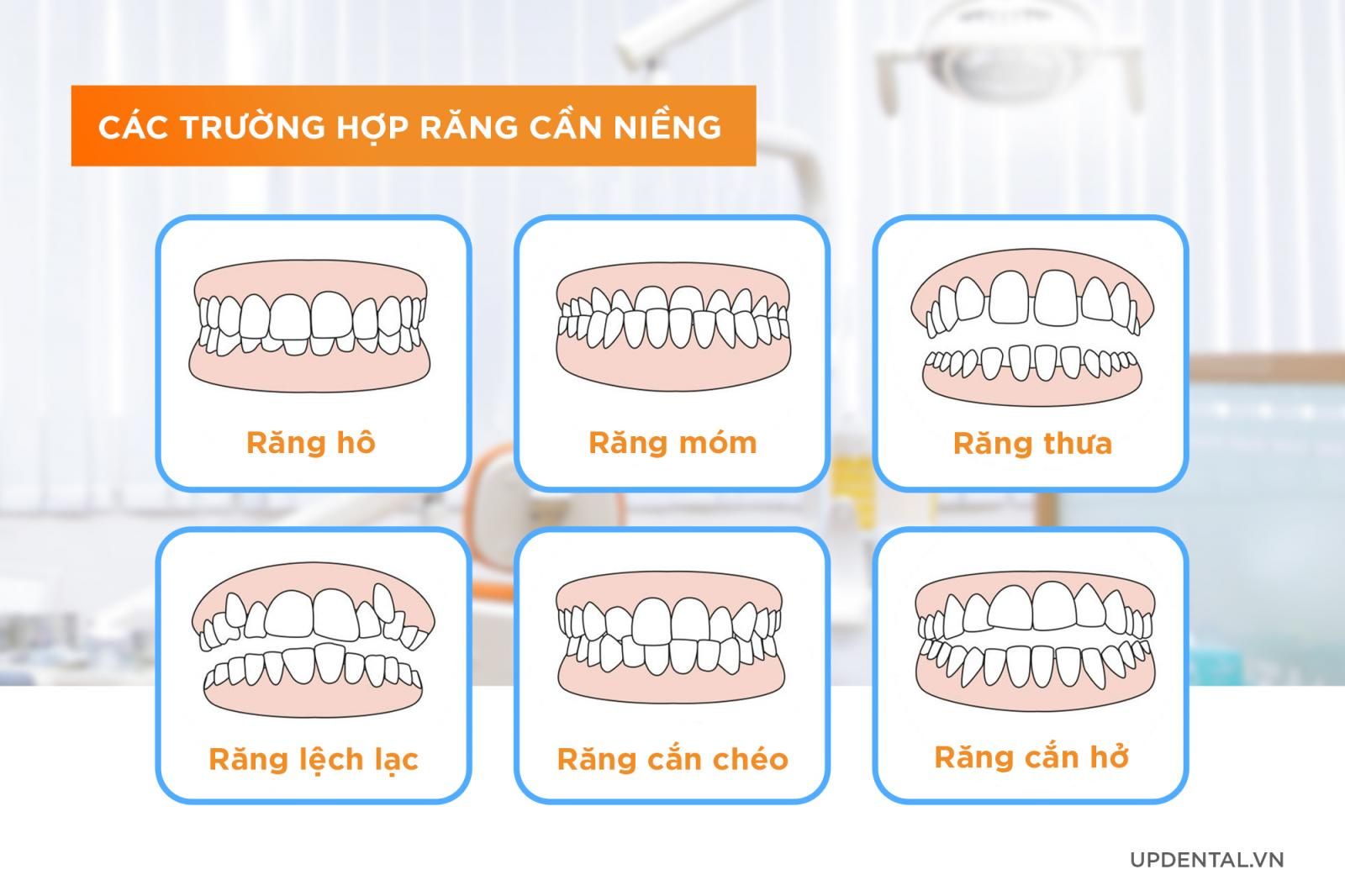 cac-truong-hop-rang-can-nieng