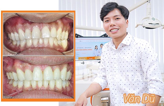 hinh-anh-truoc-va-sau-khi-nieng-rang-tai-up-dental