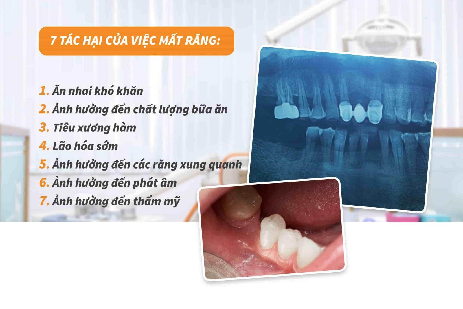 7 tác hại của việc mất răng