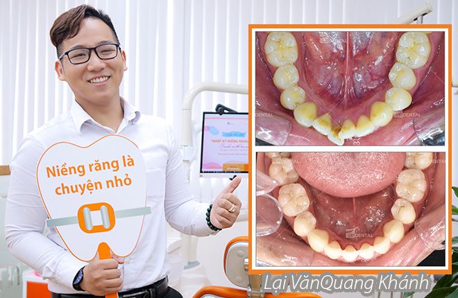 hinh-anh-truoc-va-sau-khi-nieng-rang-tai-up-dental