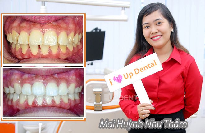 hinh-anh-truoc-va-sau-khi-nieng-rang-tai-up-dental