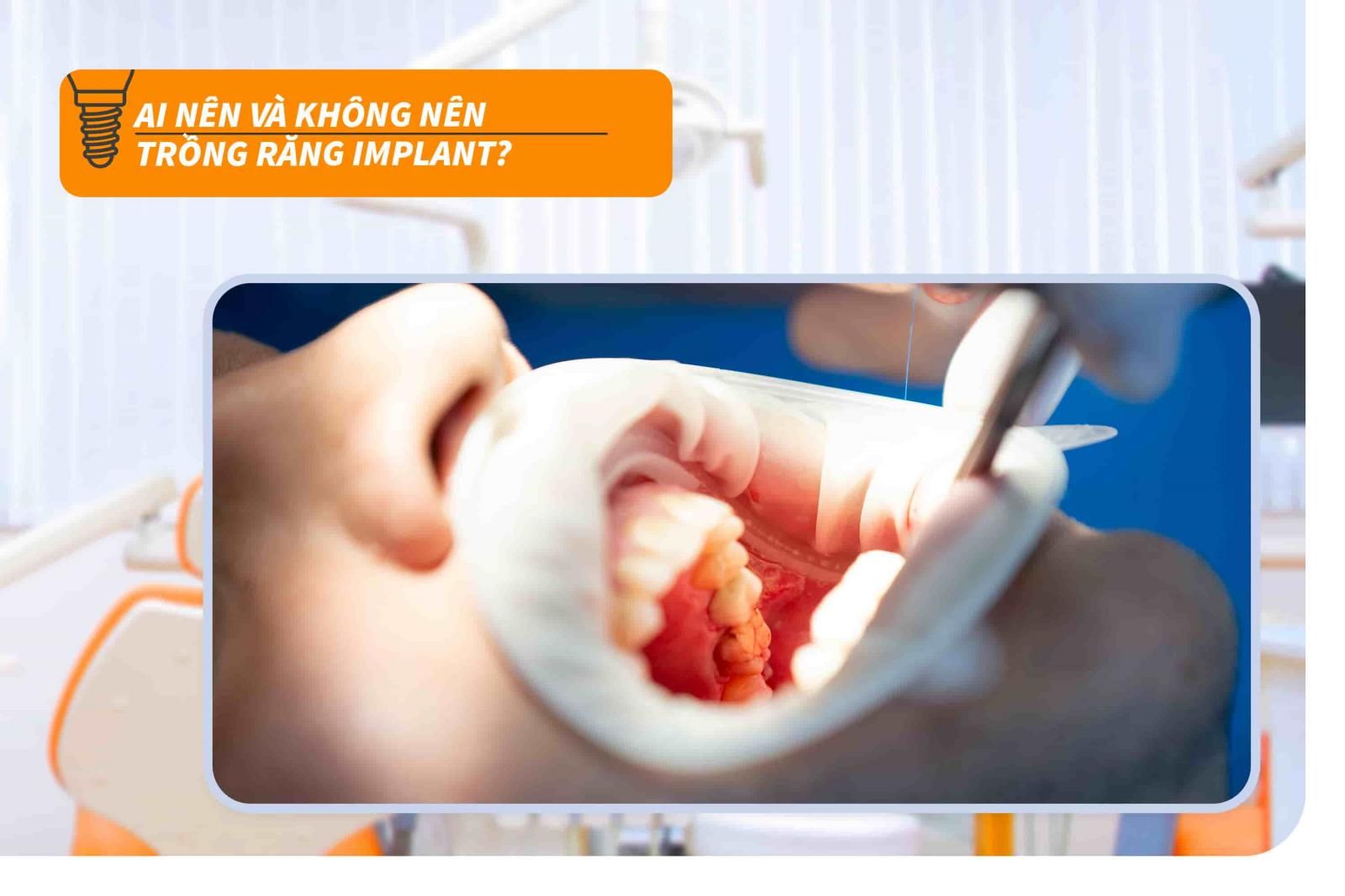 Ai nên và không nên trồng răng Implant