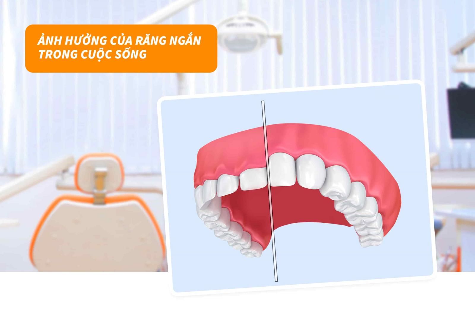 Ảnh hưởng của răng ngắn trong cuộc sống