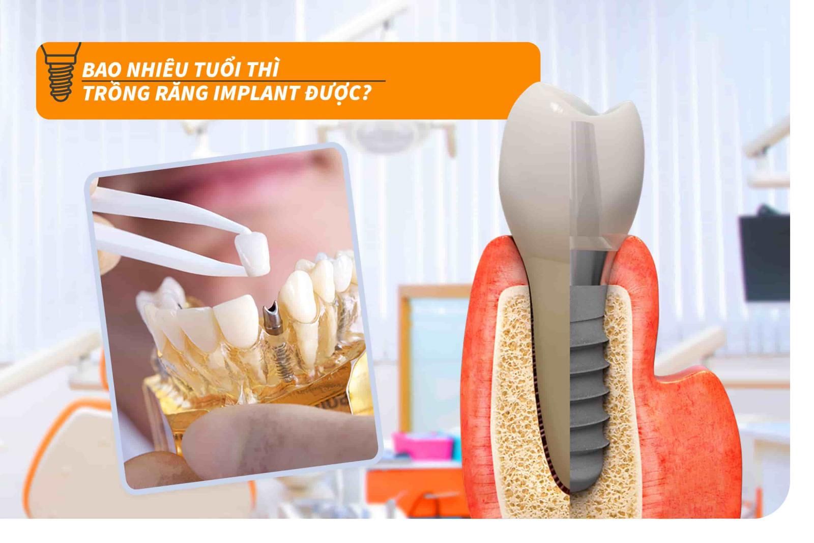 Bao nhiêu tuổi thì trồng răng Implant được?