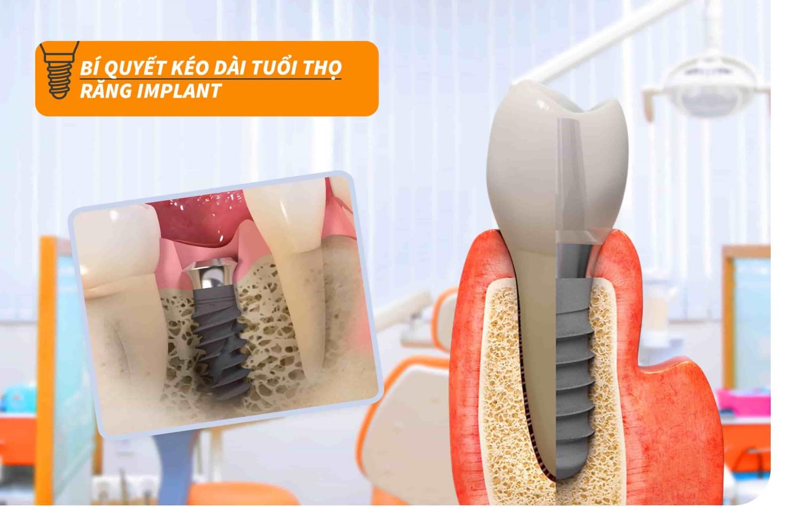 Bí quyết kéo dài tuổi thọ răng Implant