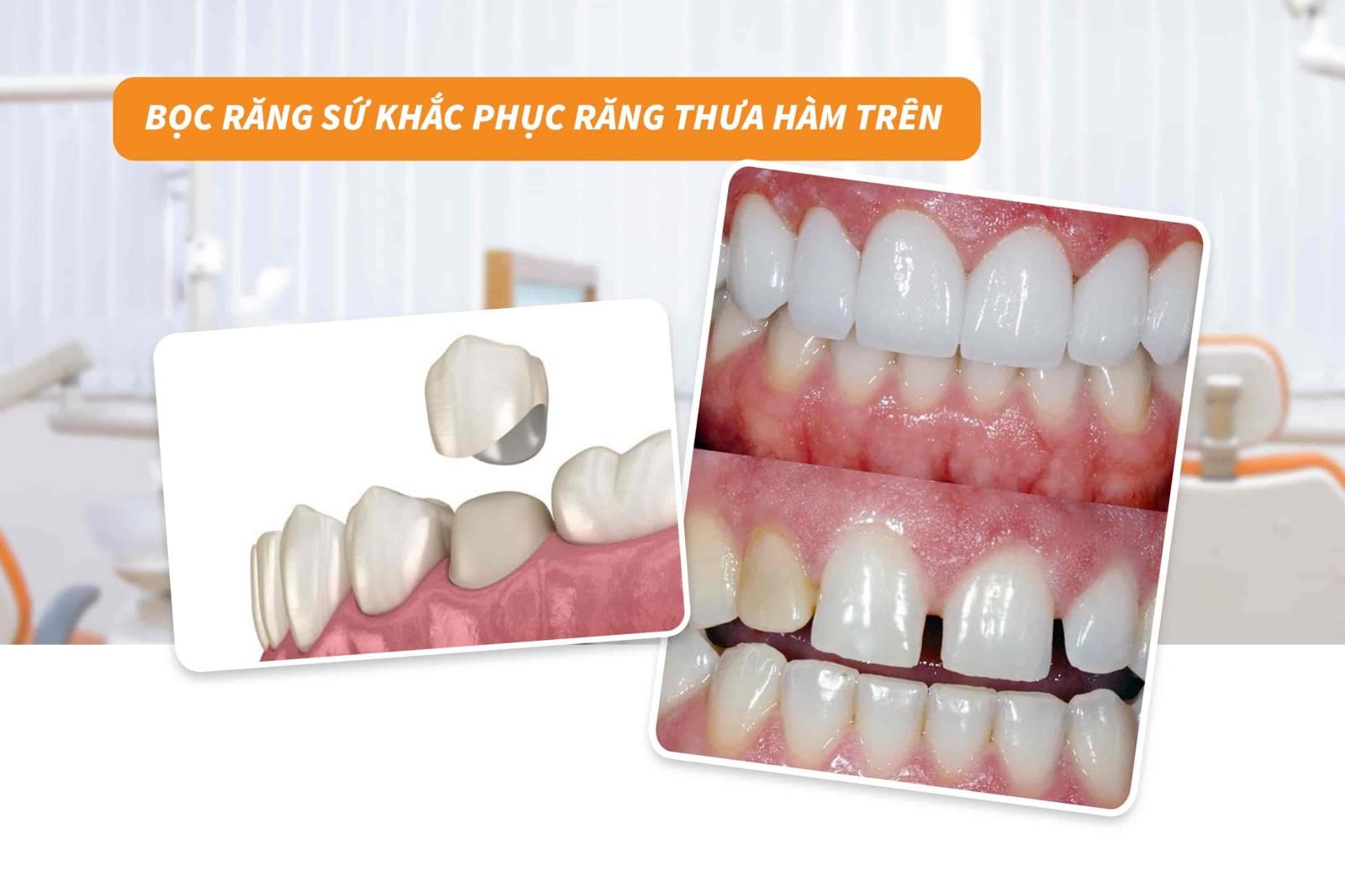 Bọc răng sứ khắc phục răng thưa hàm trên