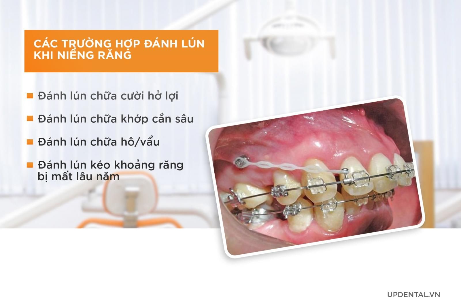 các trường hợp đánh lún khi niềng răng