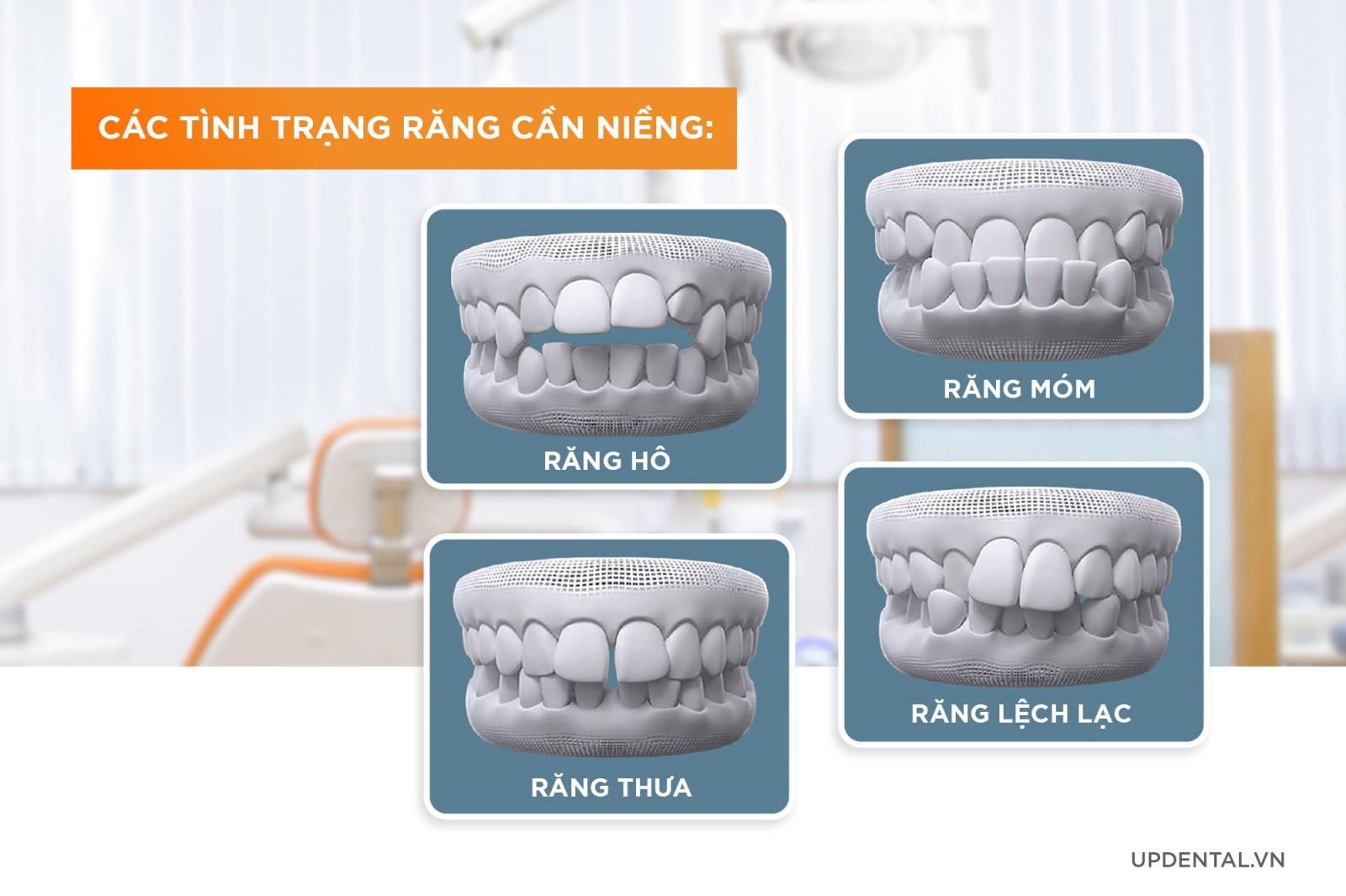 Các tình trạng răng cần phải niềng