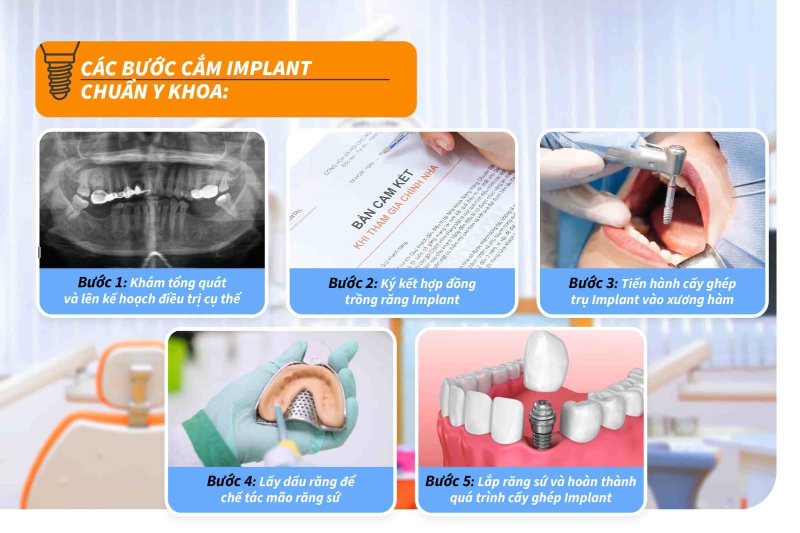 Các bước cắm Implant chuẩn Y khoa